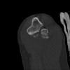 SPORK, NICO - 22.03.1976 - 02.08.2022 - CT obere Extremität - 17:58:51